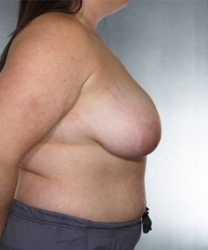 Breast Reduction Before & After Patient #8350