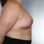 Breast Reduction Before & After Patient #8350