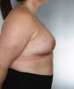 Breast Reduction Before & After Patient #8350