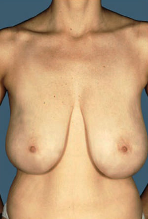 Breast Reduction Before & After Patient #8355