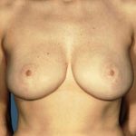 Breast Reduction Before & After Patient #8355