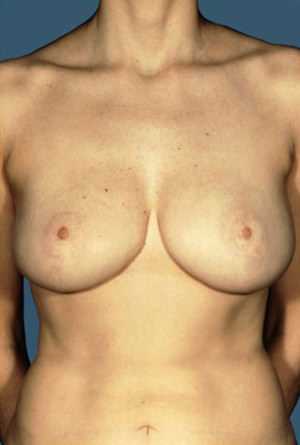 Breast Reduction Before & After Patient #8355