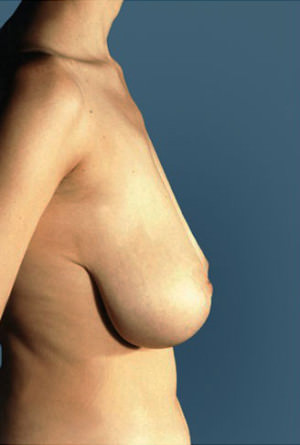 Breast Reduction Before & After Patient #8355