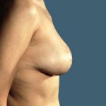 Breast Reduction Before & After Patient #8355