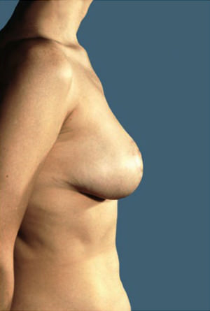 Breast Reduction Before & After Patient #8355