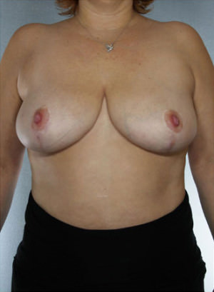 Breast Reduction Before & After Patient #8375