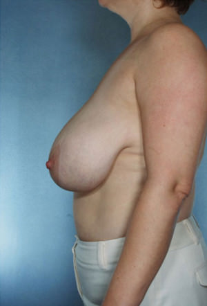 Breast Reduction Before & After Patient #8375