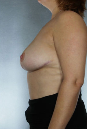 Breast Reduction Before & After Patient #8375