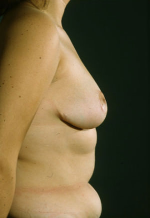 Breast Reduction Before & After Patient #8383