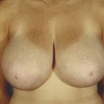 Breast Reduction Before & After Patient #8388