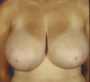 Breast Reduction Before & After Patient #8388
