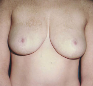 Breast Reduction Before & After Patient #8388
