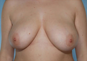 Breast Reduction Before & After Patient #8393