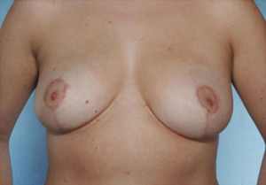 Breast Reduction Before & After Patient #8393