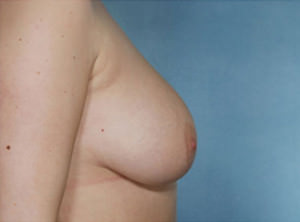 Breast Reduction Before & After Patient #8393