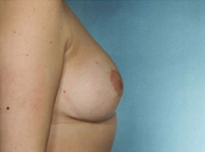 Breast Reduction Before & After Patient #8393