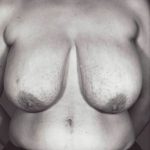 Breast Reduction Before & After Patient #8398