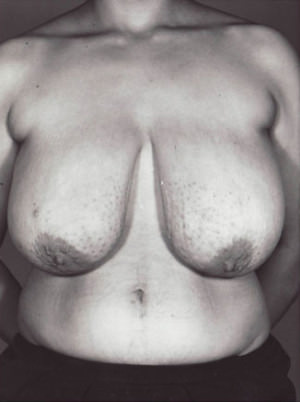 Breast Reduction Before & After Patient #8398