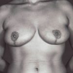 Breast Reduction Before & After Patient #8398