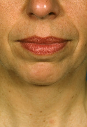 Facelift Before & After Patient #9221