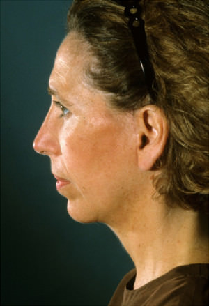 Facelift Before & After Patient #9221