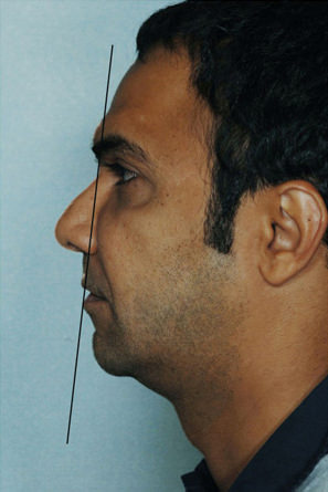Rhinoplasty Before & After Patient #8901