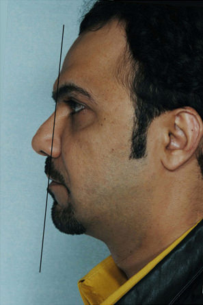 Rhinoplasty Before & After Patient #8901