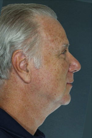Chin Augmentation Before & After Patient #9340