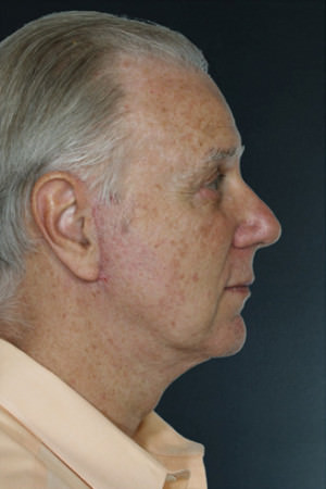 Chin Augmentation Before & After Patient #9340