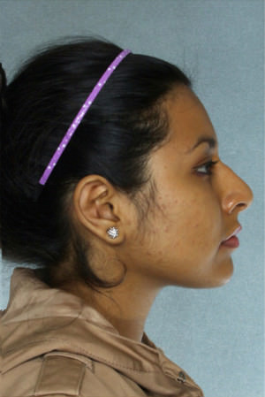 Otoplasty Before & After Patient #9109