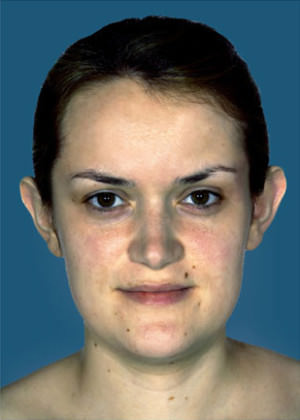 Otoplasty Before & After Patient #9149