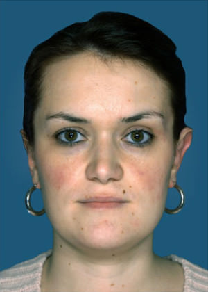 Otoplasty Before & After Patient #9149