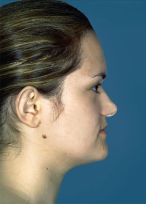 Otoplasty Before & After Patient #9149