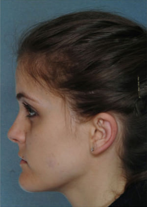 Otoplasty Before & After Patient #9154