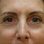 Blepharoplasty Before & After Patient #8781