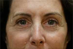 Blepharoplasty Before & After Patient #8781