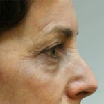 Blepharoplasty Before & After Patient #8781