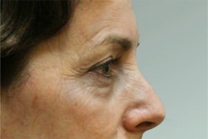 Blepharoplasty Before & After Patient #8781