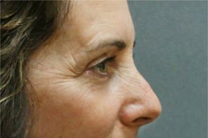 Blepharoplasty Before & After Patient #8781