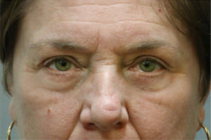 Blepharoplasty Before & After Patient #8786