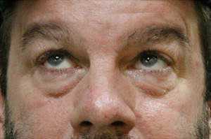 Blepharoplasty Before & After Patient #8789