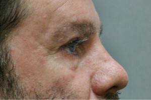 Blepharoplasty Before & After Patient #8789