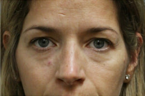 Blepharoplasty Before & After Patient #8796