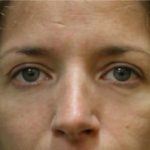 Blepharoplasty Before & After Patient #8796