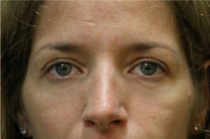 Blepharoplasty Before & After Patient #8796