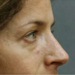 Blepharoplasty Before & After Patient #8796