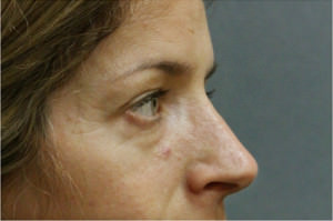 Blepharoplasty Before & After Patient #8796