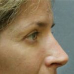 Blepharoplasty Before & After Patient #8796