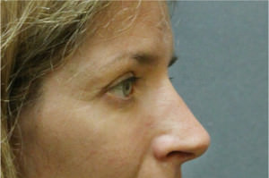 Blepharoplasty Before & After Patient #8796