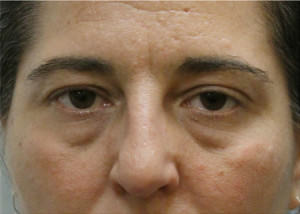 Blepharoplasty Before & After Patient #8801
